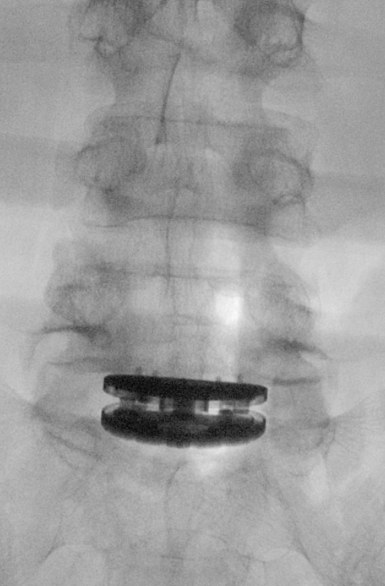 Disc replacement placement during surgery, front view