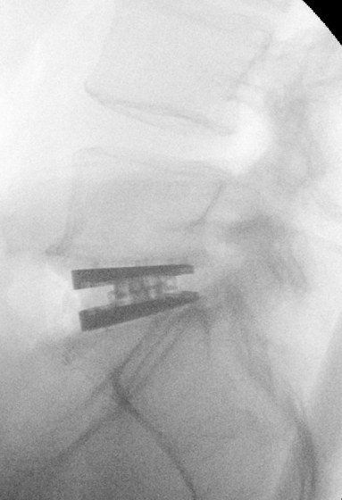 Disc replacement placement during surgery, side view