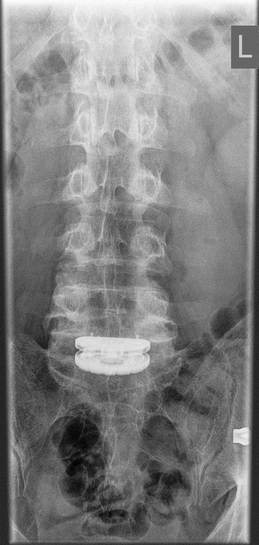 Day one after surgery, front view