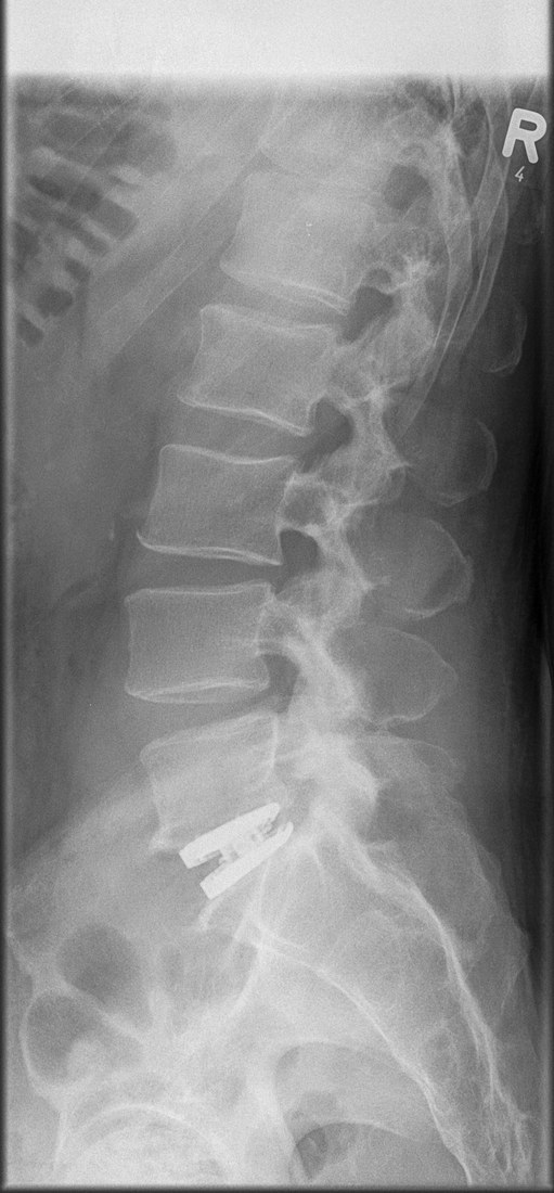 Day one after surgery, side view