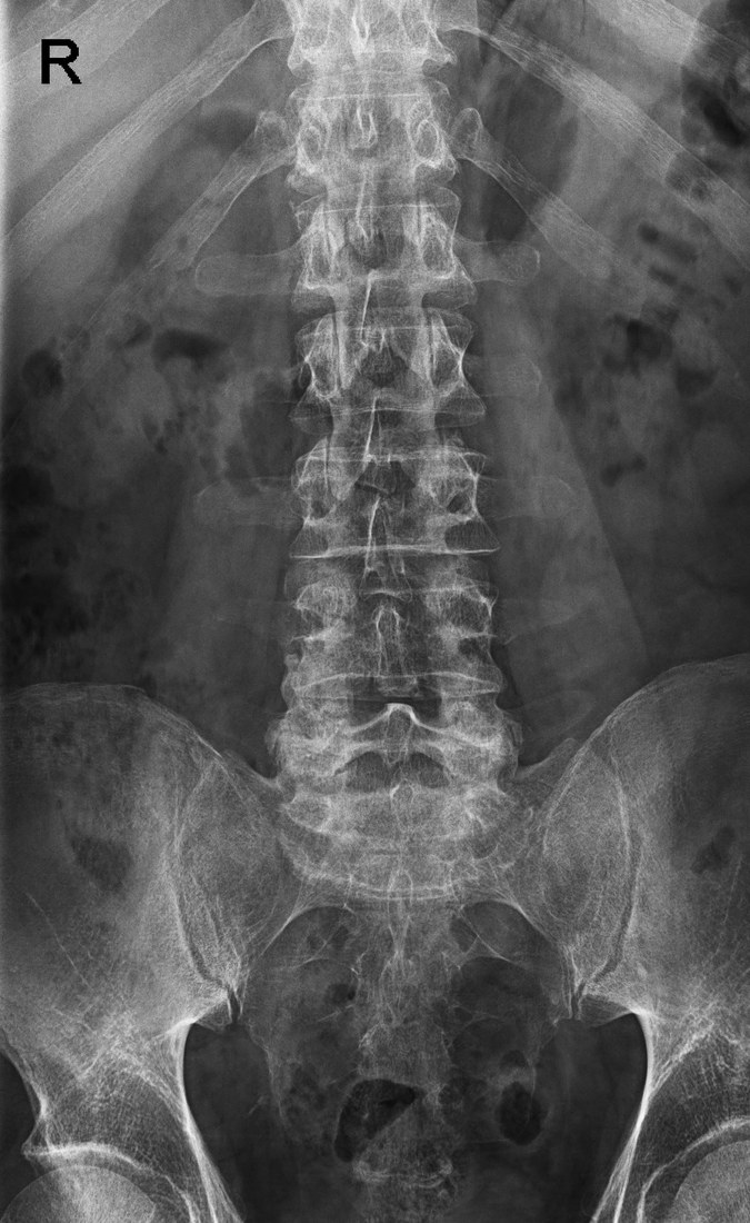 Pre-surgery lumbar spine, front view