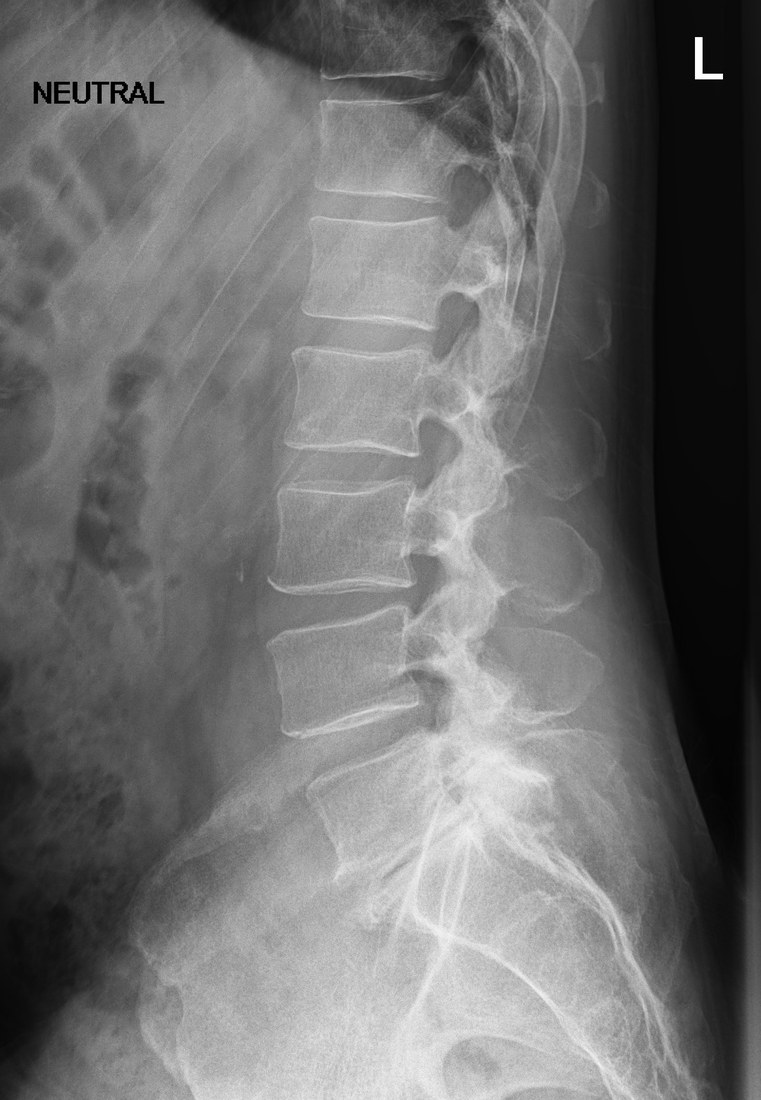 Pre-surgery lumbar spine, side view